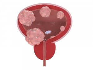 Cancerul de vezica urinara (vezical): Cauze, diagnostic, tratament | auto-bazar.ro