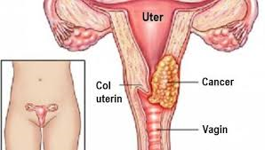 biopsie a condilomului plat al colului uterin