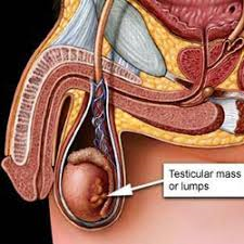 durata supravietuire cancer prostata prostatita slăbește sistemul imunitar